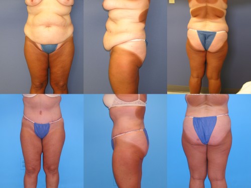 Bruising & Swelling after Tummy Tuck/Abdominoplasty Surgery