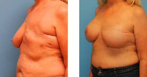 Breast Reconstruction: Back Tissue and Muscle